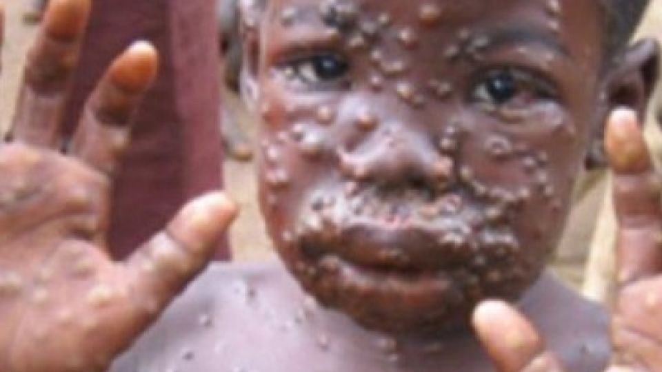 Monkeypox-in-Cameroon.jpg